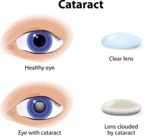 Cataract 300x274 1