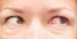 Conjunctivitis west springfield | Longwood Eye & LASIK Center