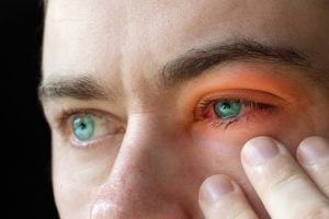 Man with Viral Blepharitis