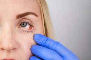 ophthalmologist examines a woman who complains of a burning sensation and pain in her eyes