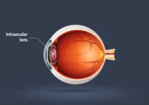 Longwood Eye & Lasik intraocular lenses