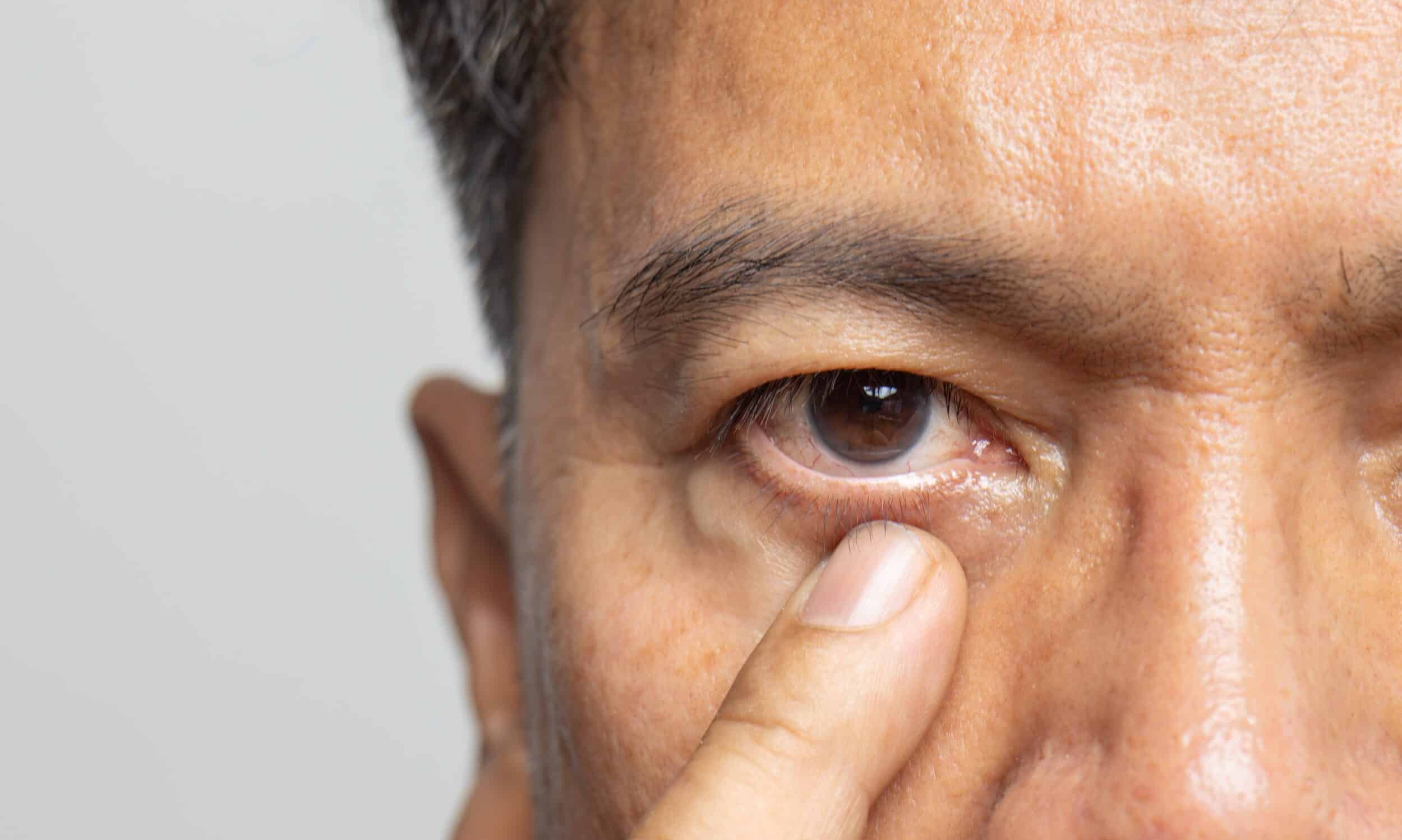 How To Treat Eye Twitching (Blepharospasm)